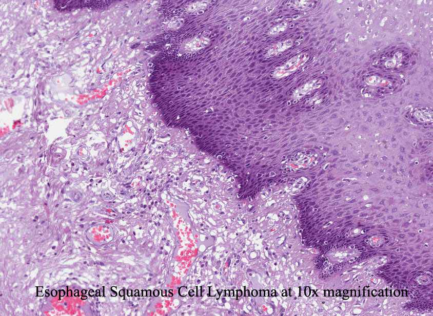 Esophageal Squamous Cell Lymphoma at 10x magnification